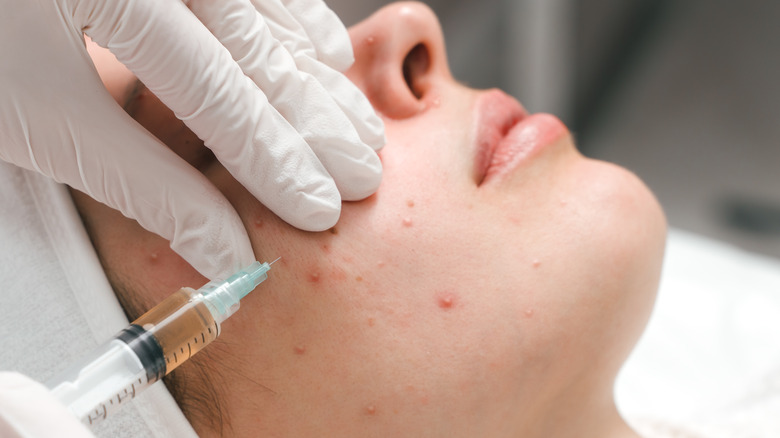 Person getting acne cortisone injection