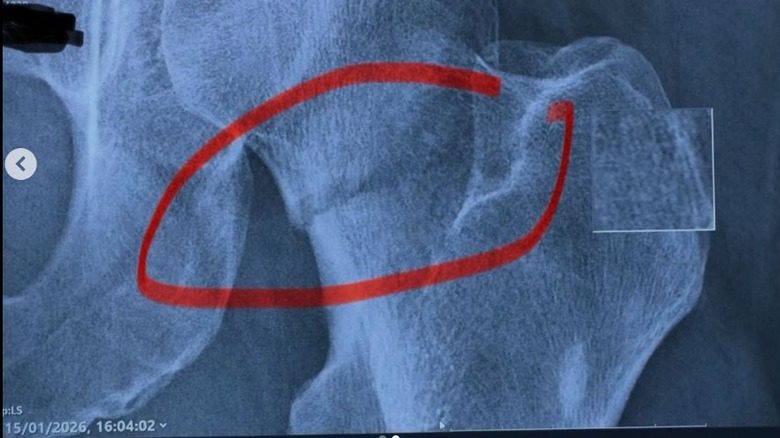 Image of Piers Morgan's broken femur bone