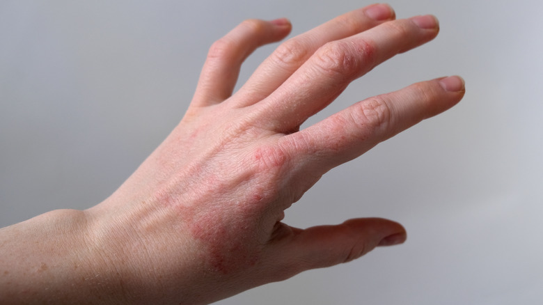 Hand with eczema