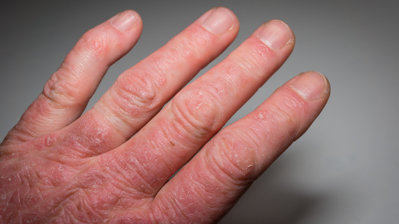 hand with psoriatic arthritis