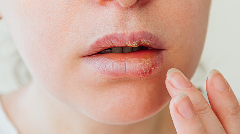 closeup of woman's lip with herpes