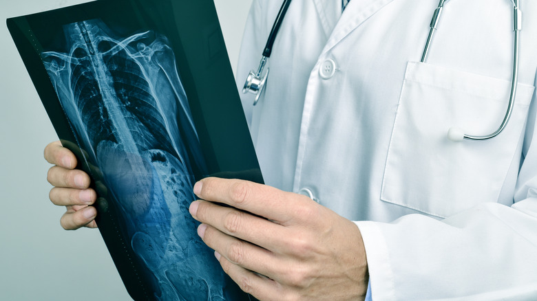 doctor holding chest x-ray