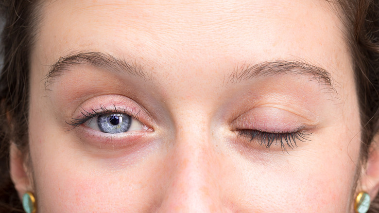 Woman with droopy eyelid