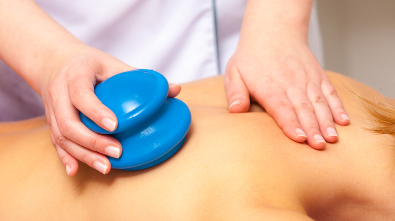 cupping therapy
