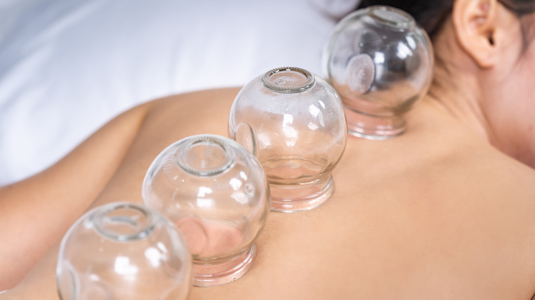 cupping therapy