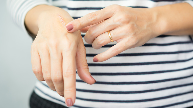 woman rubbing scar on wrist