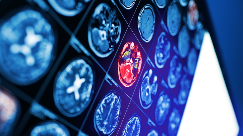 MRI brain scans