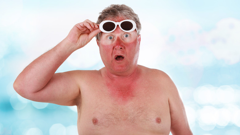 man with sunburn