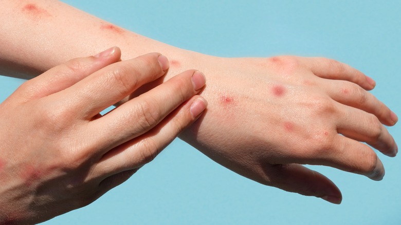 close-up of a patient's arm with monkeypox rash