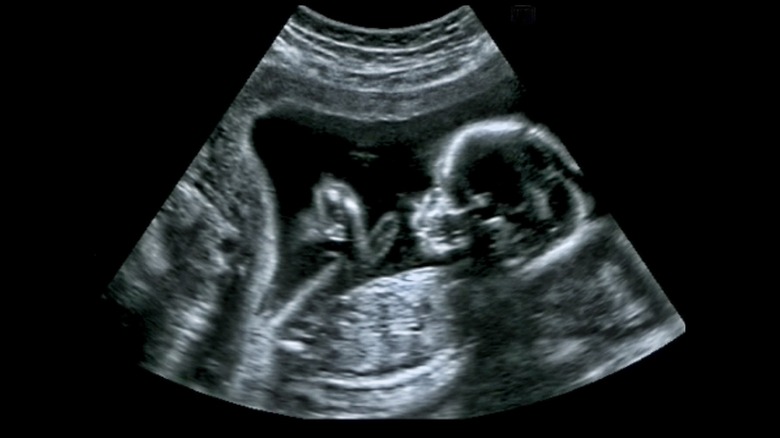 Fetal ultrasound image