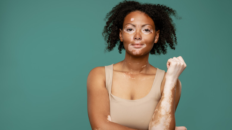 black woman with vitiligo posing 