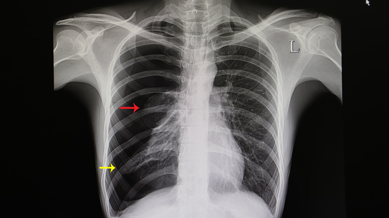X-ray of collapsed lung