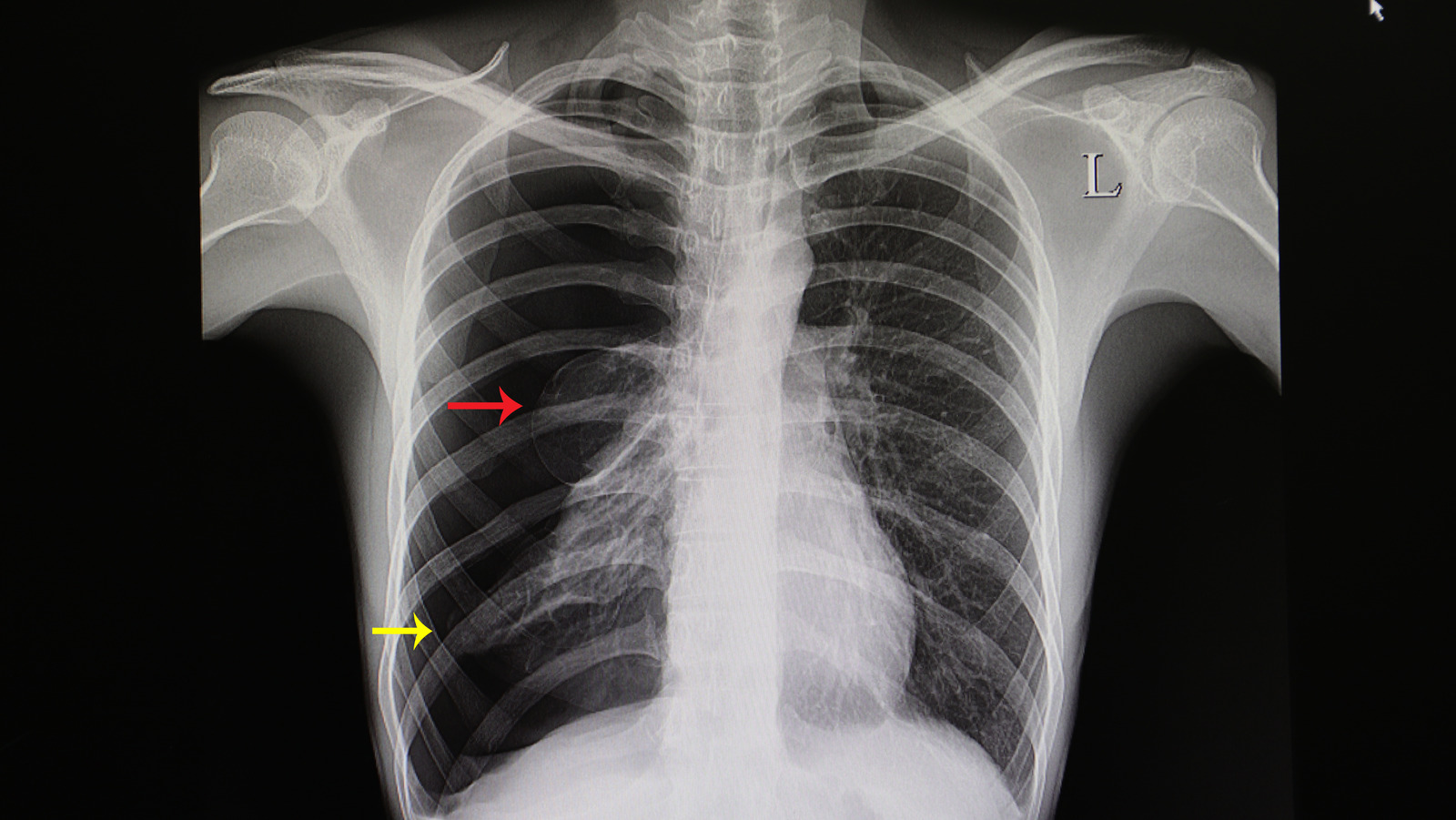 How Serious Is A Collapsed Lung?