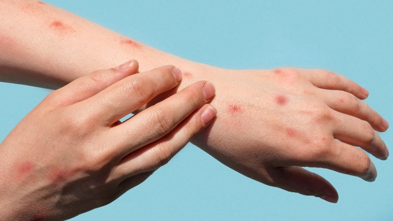 monkeypox lesions stigma