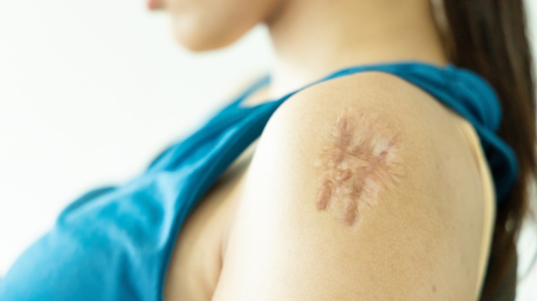 keloid scar on a woman's shoulder