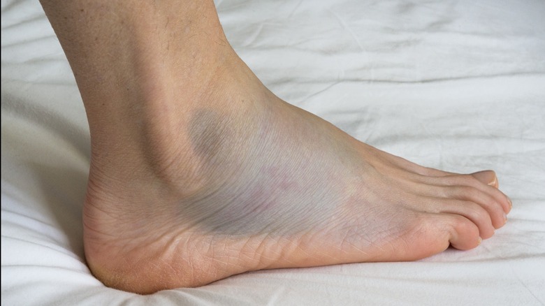 foot hematoma