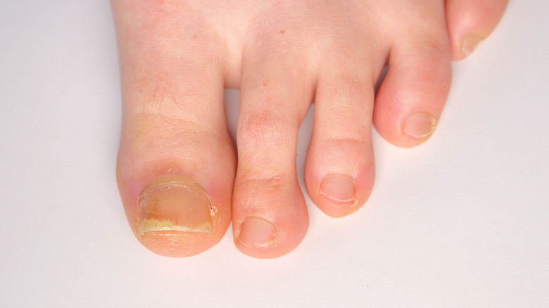 toenails affected by psoriatic arthritis