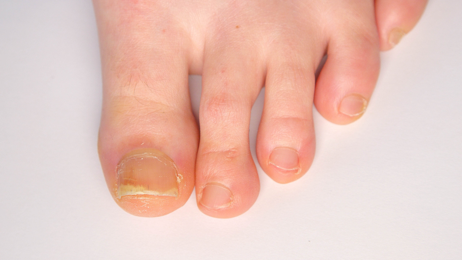 Nail Psoriasis: Overview of Nail Psoriasis, Pathophysiology of Nail  Psoriasis, Epidemiology of Nail Psoriasis