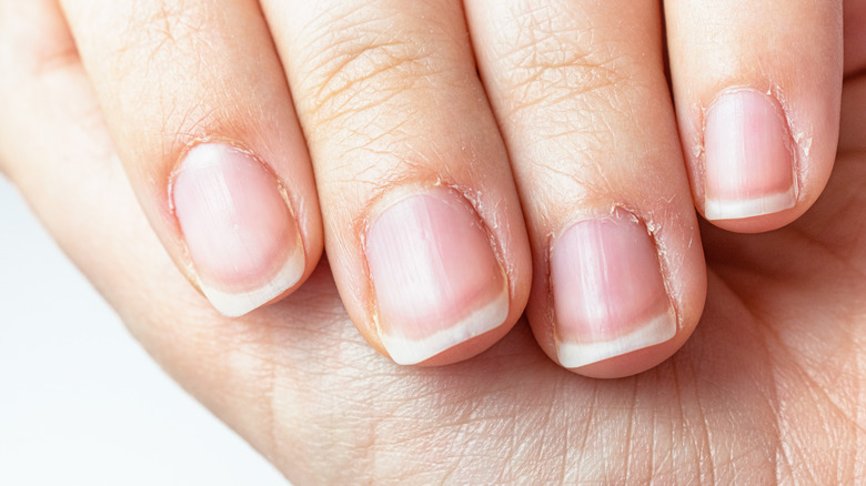 How To Care For Nails Affected By Psoriatic Arthritis