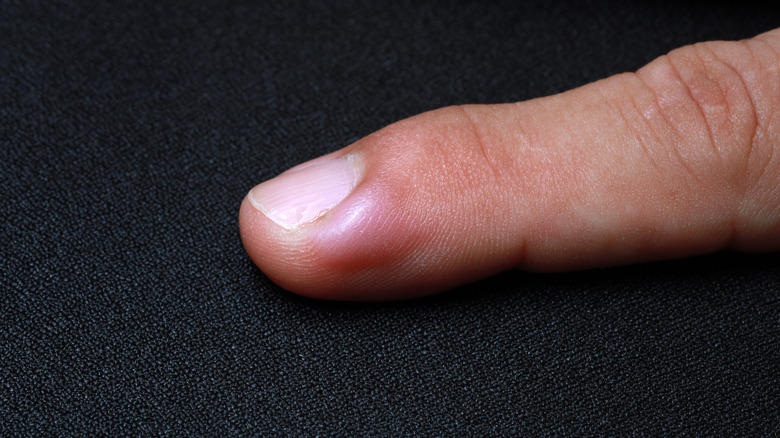 infected area near fingernail