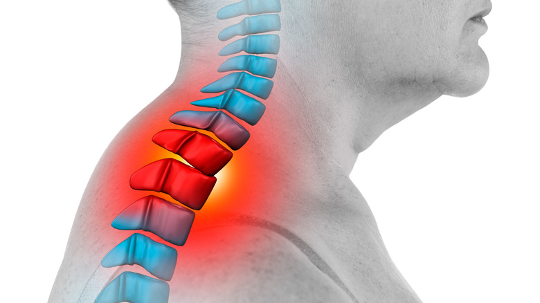 Spinal inflammation graphic on neck hump