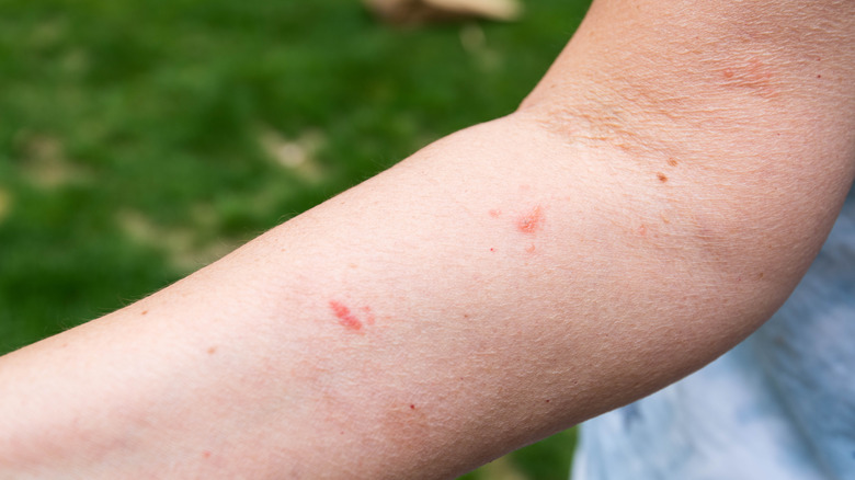 poison sumac rash on arm