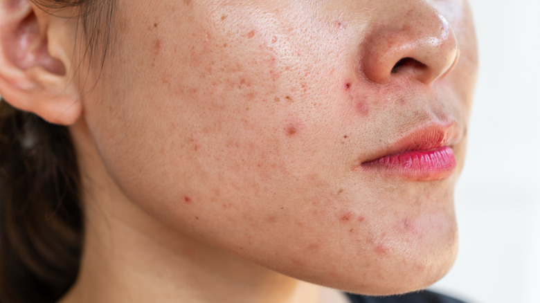 A woman has acne