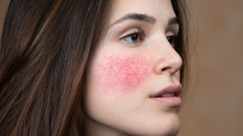 pretty white woman with rosacea