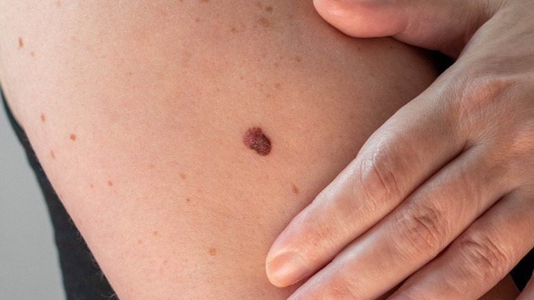 unusual mole melanoma on arm