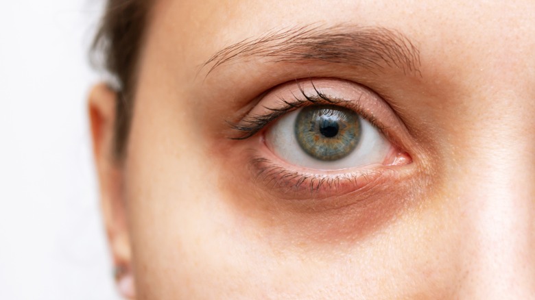 woman's face with dark circle under eye