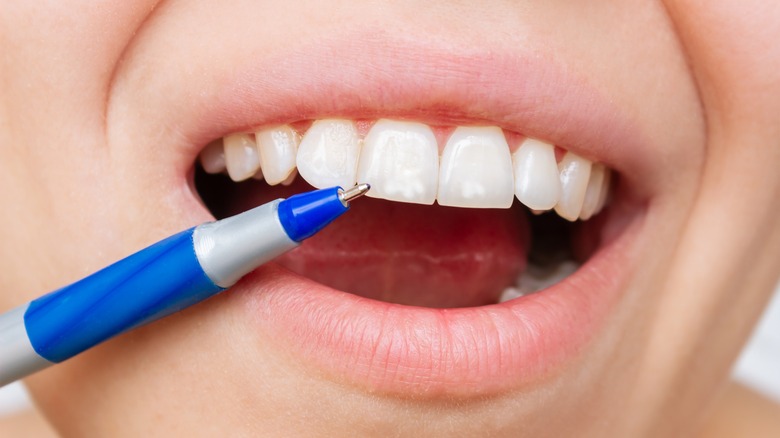 person smiling showing white spots on teeth