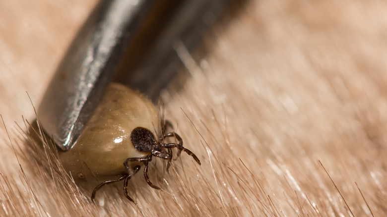 Tick being plucked with tweezers