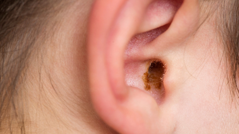 dirty ear with earwax of child