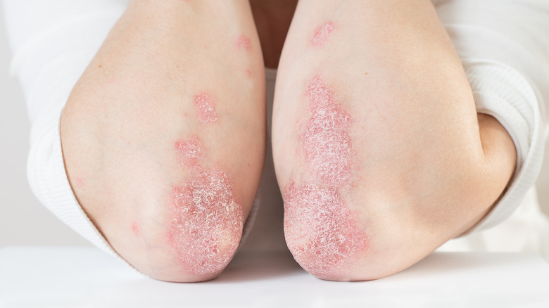 acute psoriasis on elbow