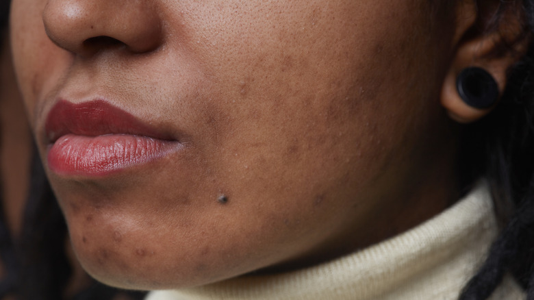 Closeup of woman's face with acne marks