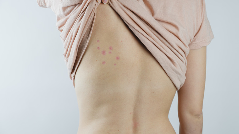 bed bug bites on the back of a woman 