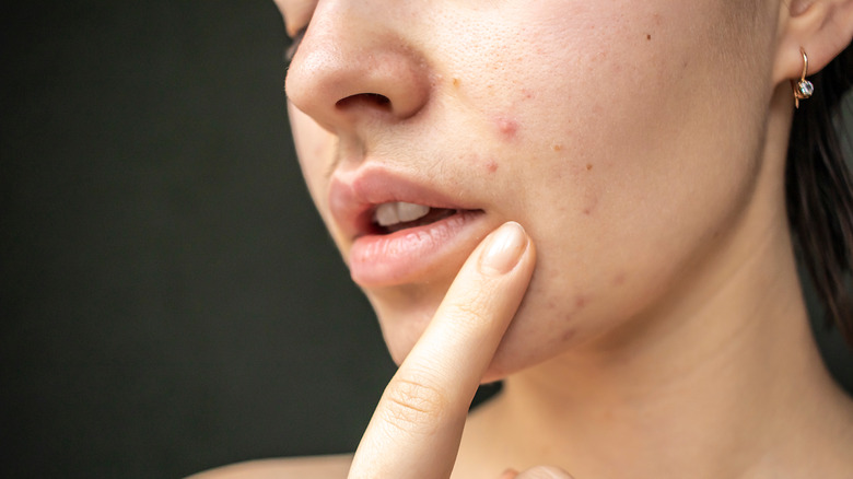 woman pointing to acne on face