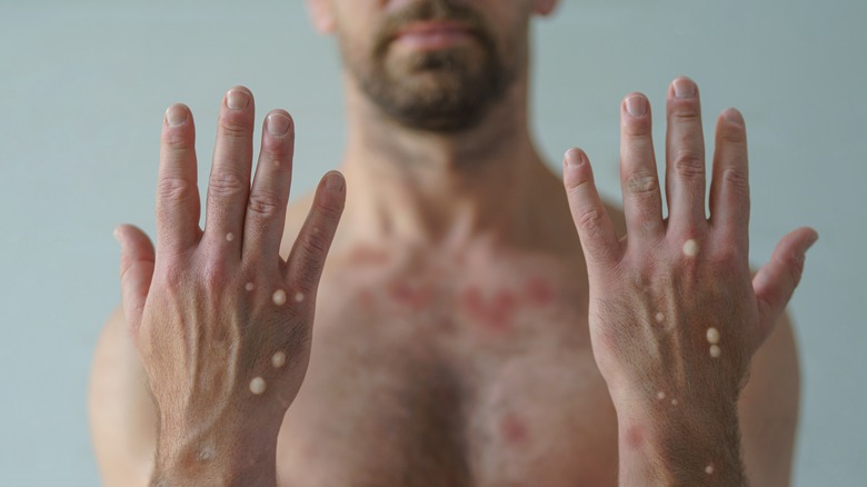 blisters on top of hands