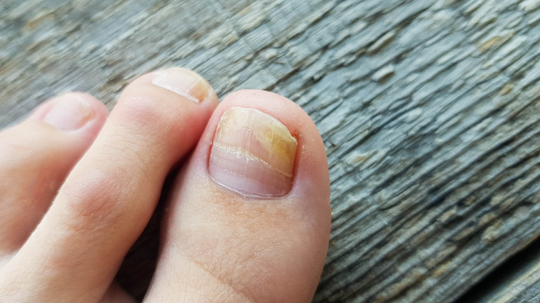 How To Tell The Difference Between Nail Mold And Fungus