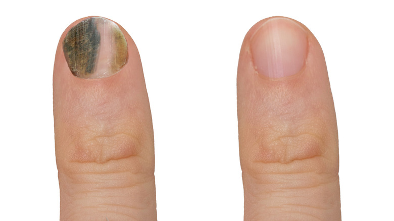 nail mold