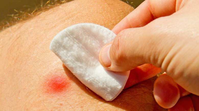 Hand dabbing at bug bite with piece of cotton gauze