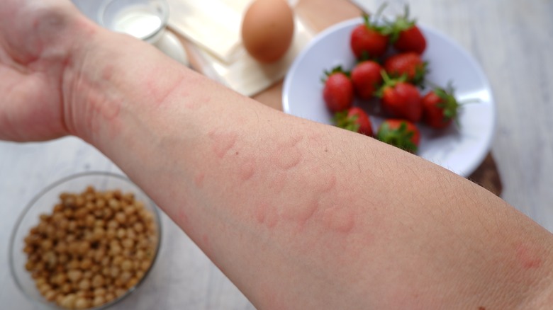 person with hives on arm