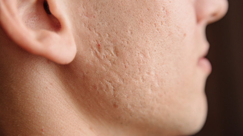 closeup of face with acne scars
