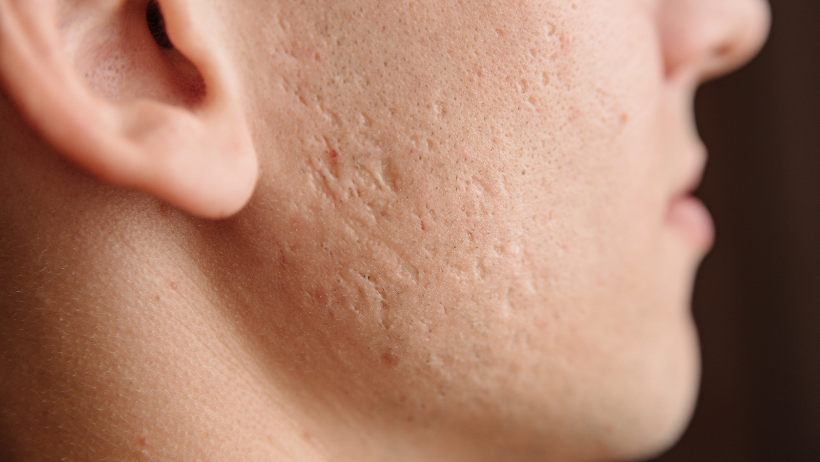 How To Treat Different Types Of Acne Scars