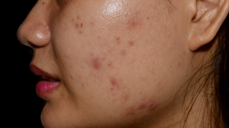 Woman with acne on face