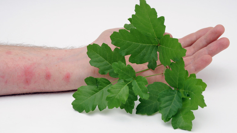 Arm with poison oak rashes