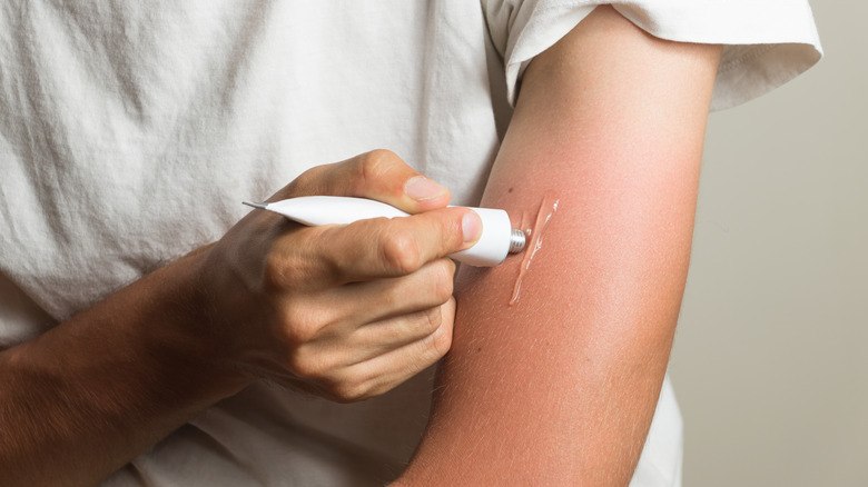applying aloe vera gel to sunburn