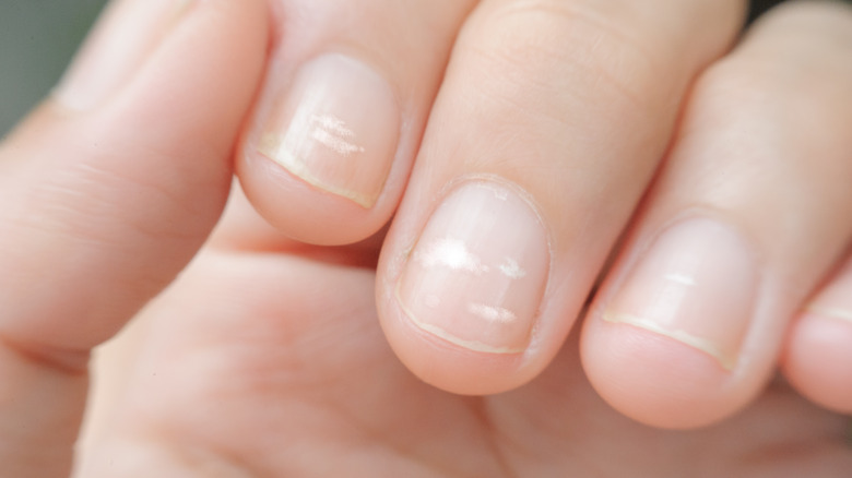white spots and lines on nails