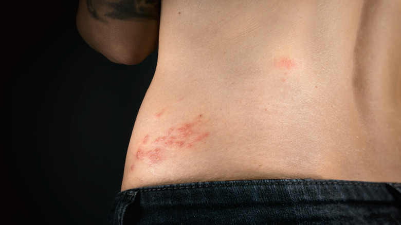 Shingles rash emerging along back torso above pants line