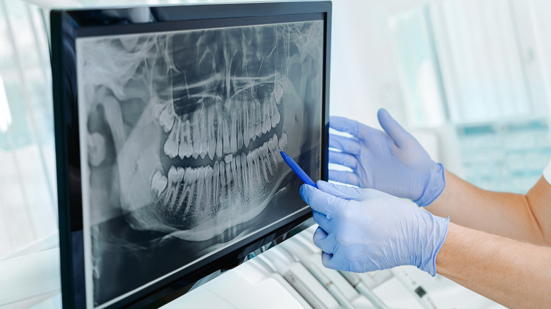 Dentist pointing to a dental X-ray